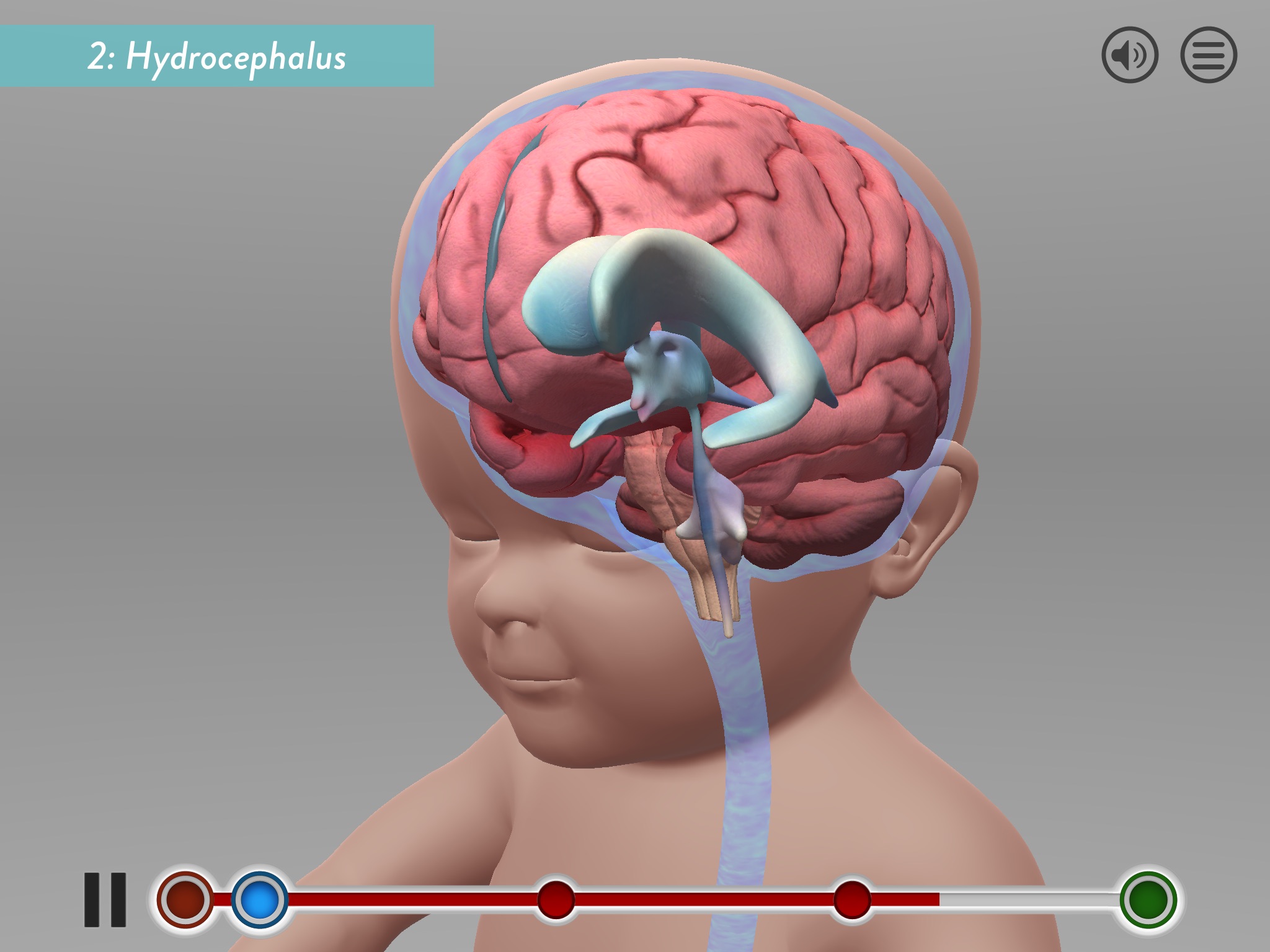 Hydrocephalus Procedure screenshot 2