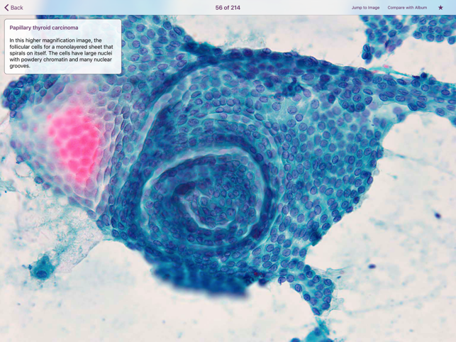 Thyroid Pathology(圖3)-速報App