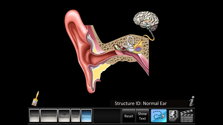 Otitis Media Disorders