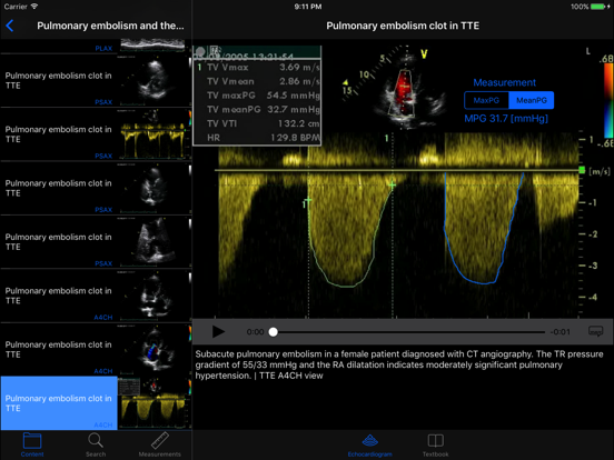 Screenshot #4 pour CARDIO3®Echocardiography HD