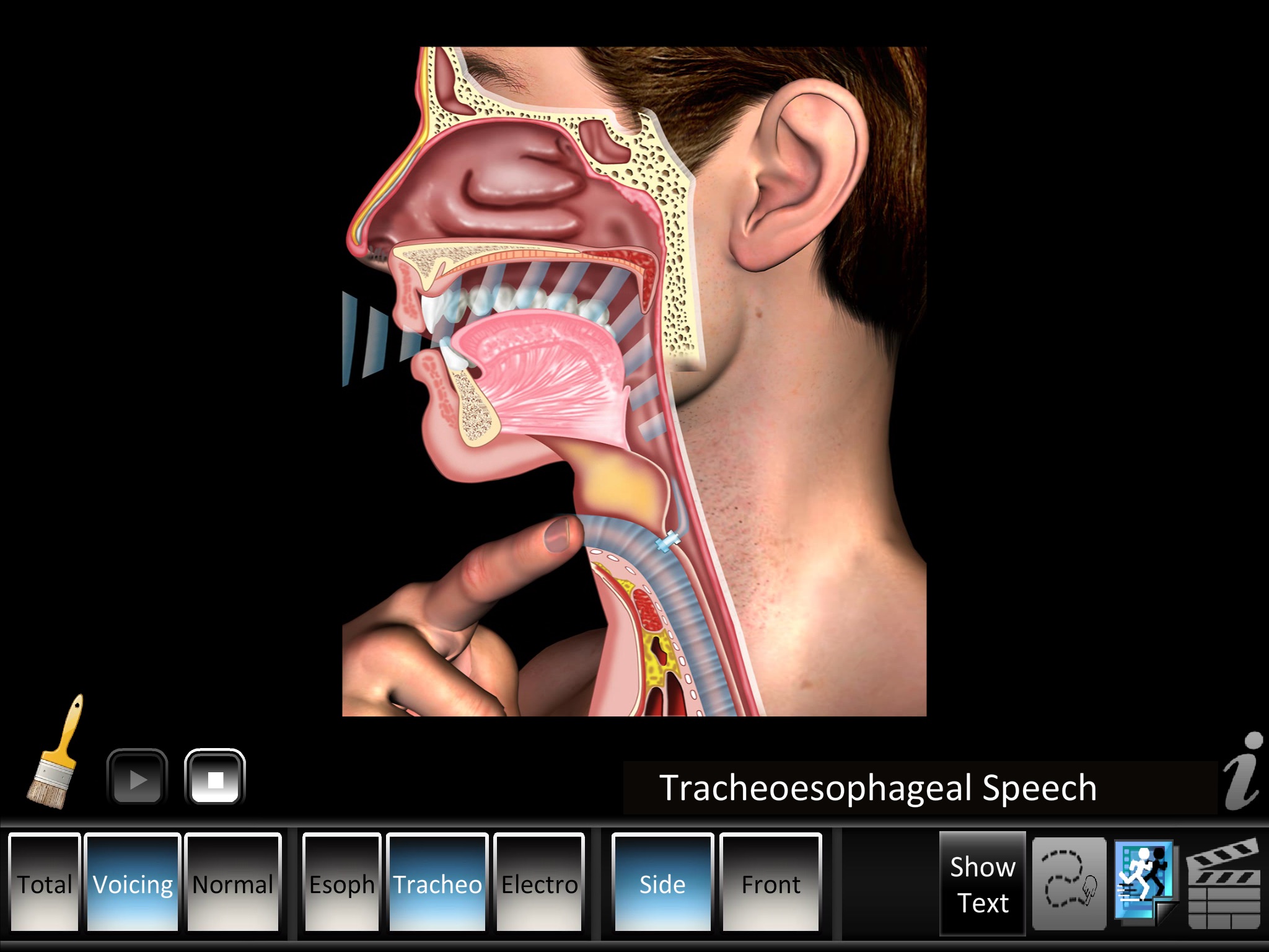 Laryngectomy screenshot 4