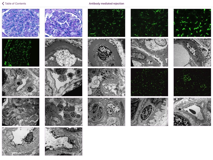 Renal Transplant Pathology