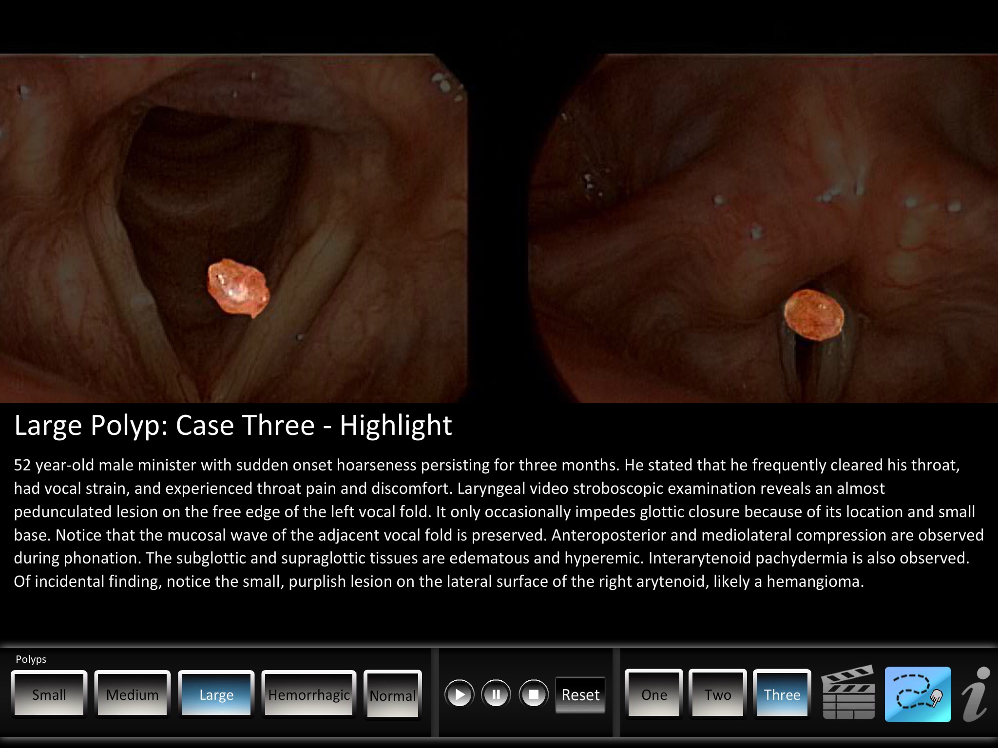 Vocal Pathology: Polyps screenshot 3