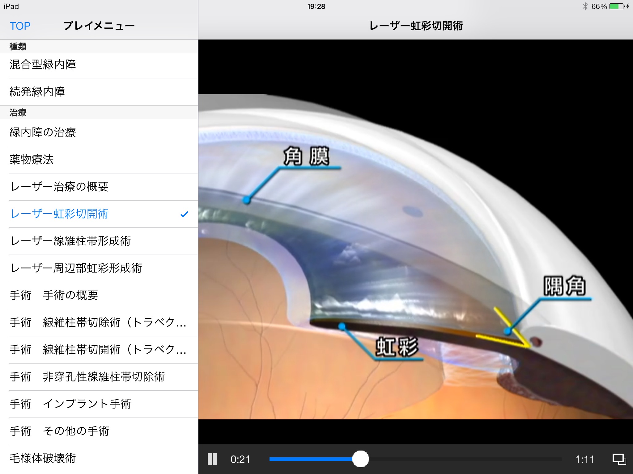 iCeye 緑内障 screenshot 2