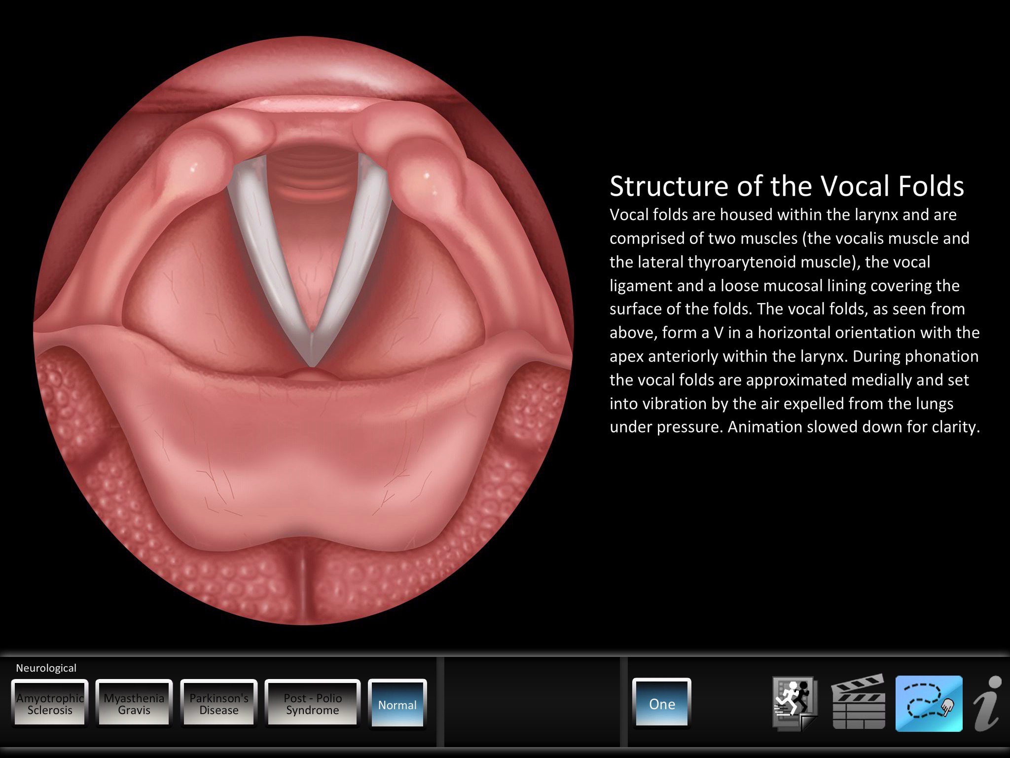 Vocal Pathology: Neurological screenshot 3