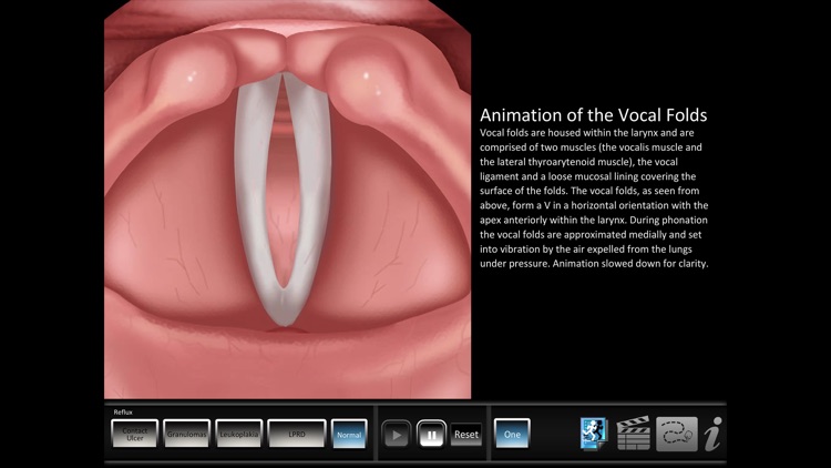 Vocal Pathology: Reflux