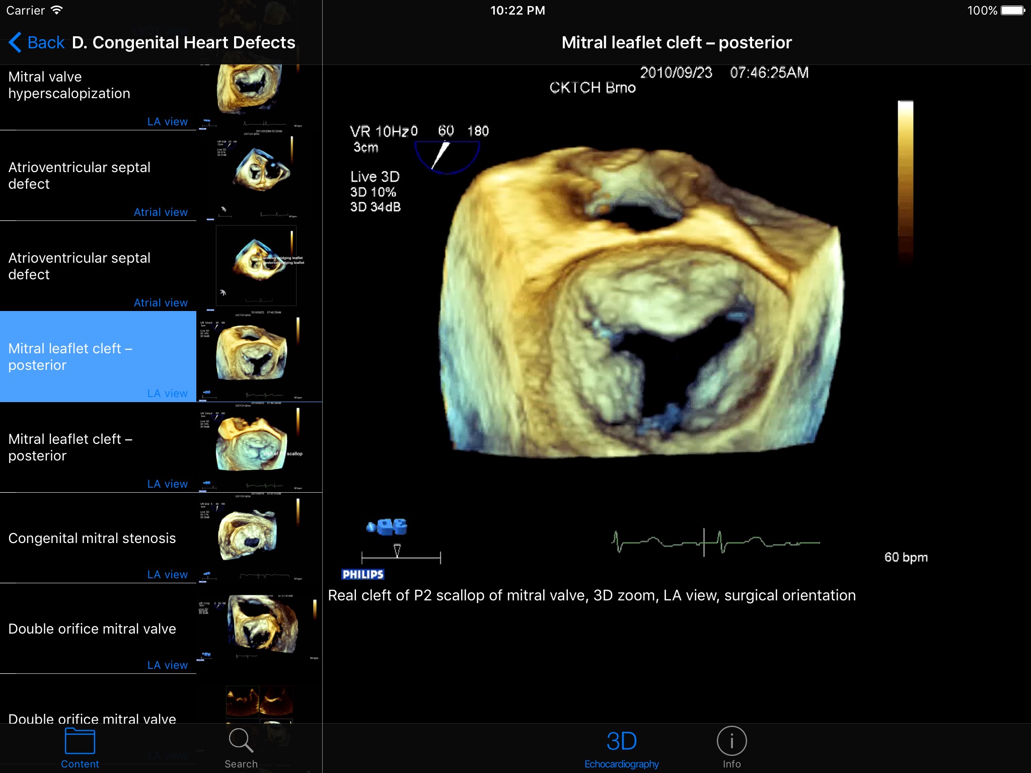 CARDIO3®3D Echocardiography HD screenshot 4