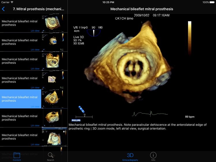 CARDIO3®3D Echocardiography HD