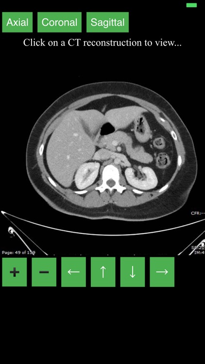 CT Abdomen Pelvis