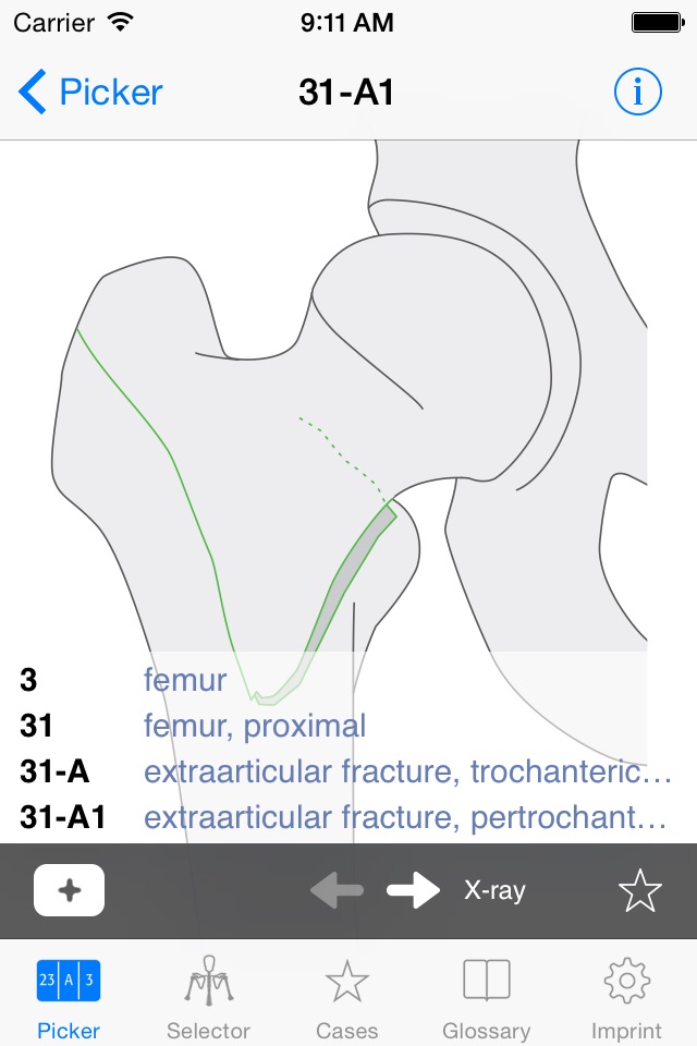 AO/OTA Fracture Classification screenshot 4