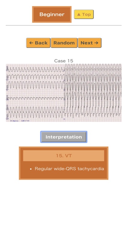 Pocket ECG