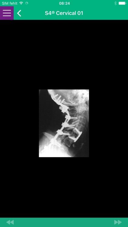 AESCULAP Spine Cervical screenshot-3