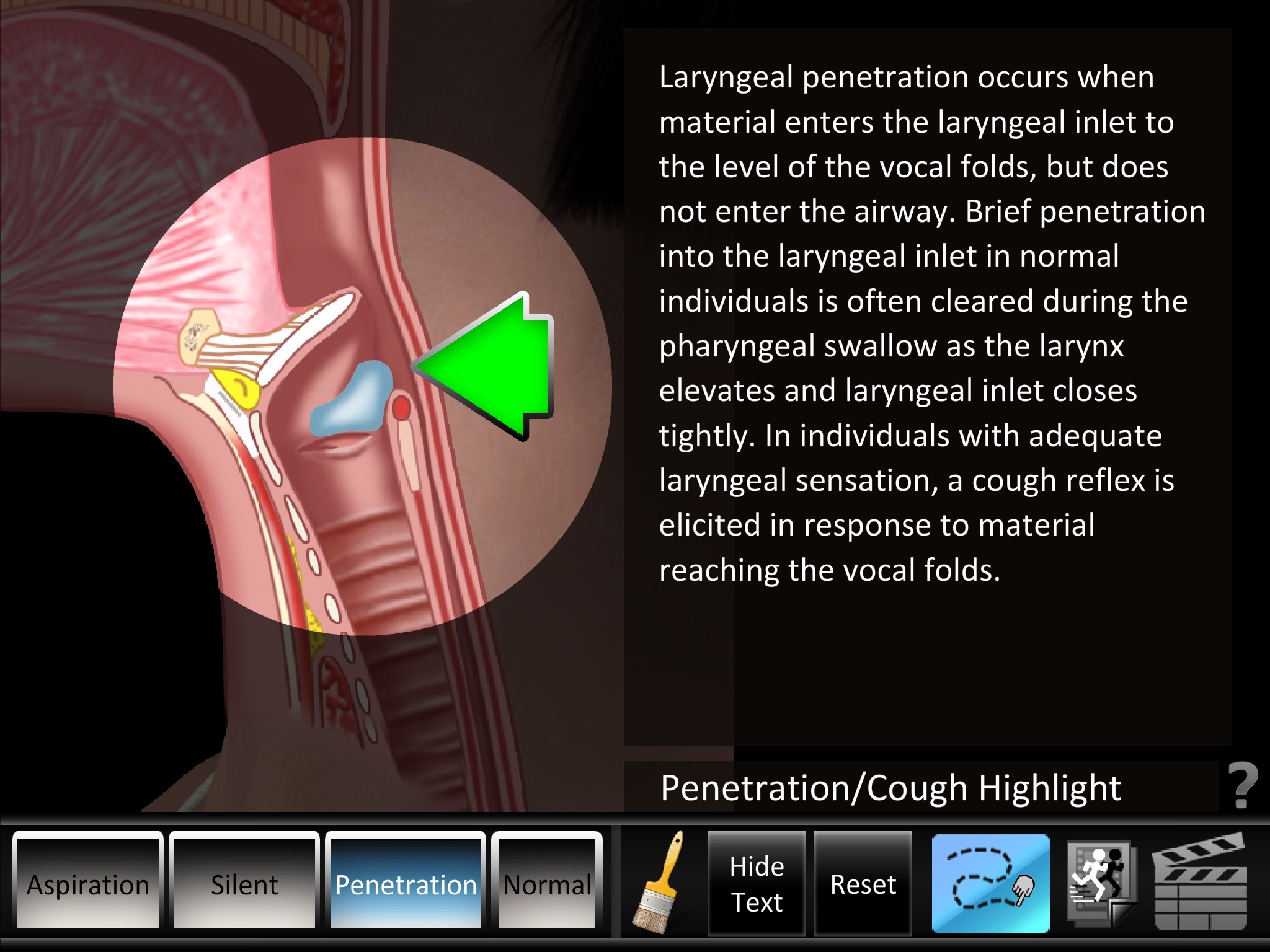 Aspiration Disorders screenshot 2