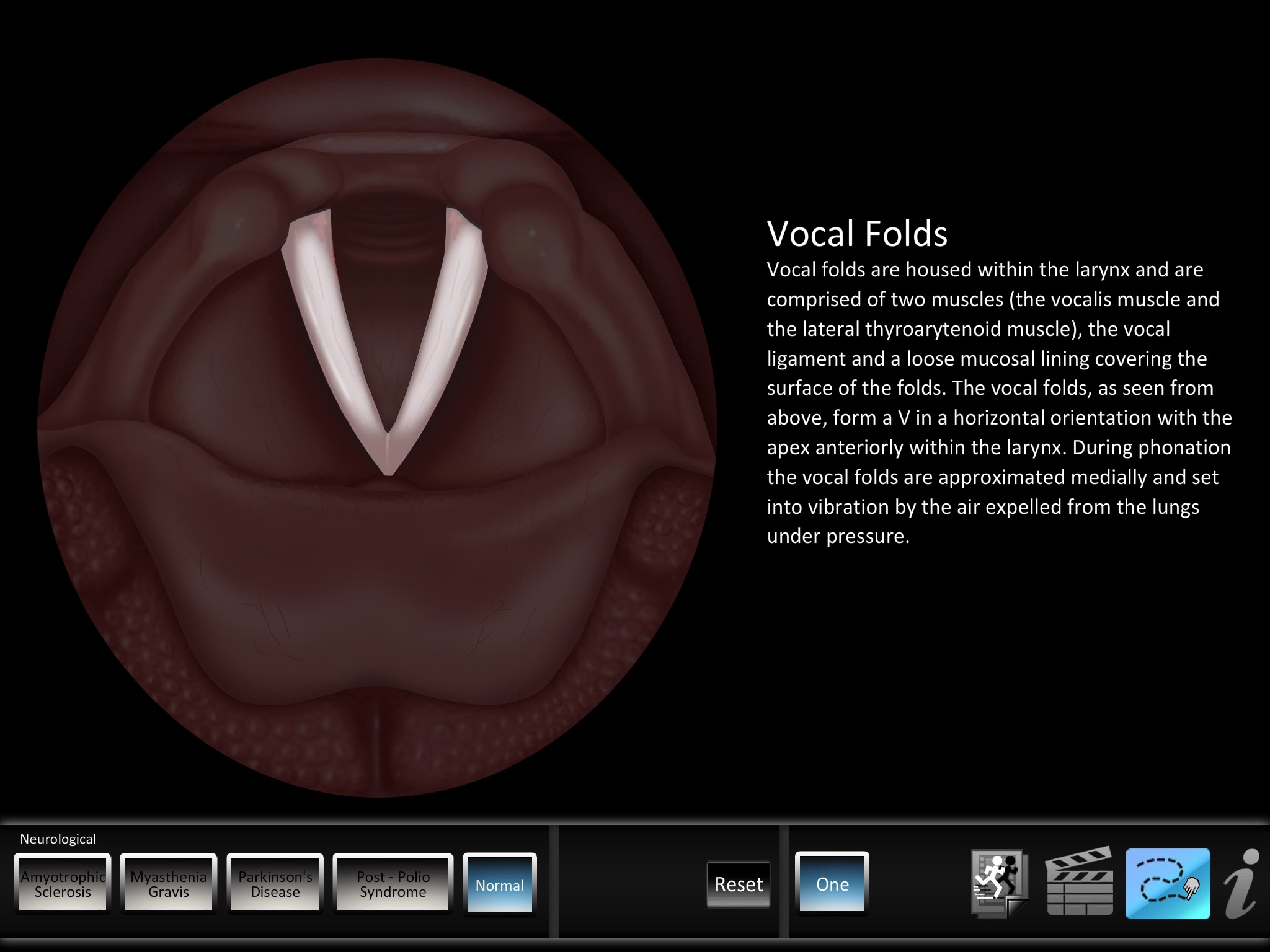 Vocal Pathology: Neurological screenshot 4