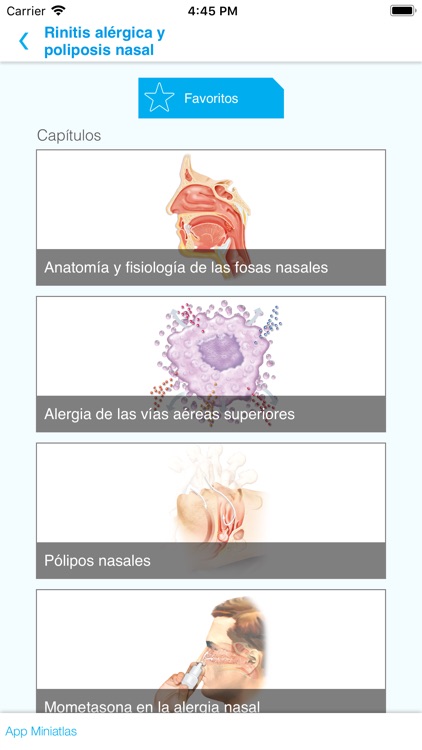 Rinitis alérgica y poliposis