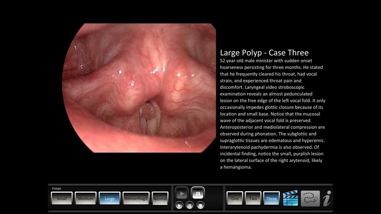 Vocal Pathology: Polyps