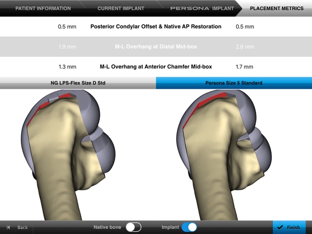 Persona® TKA Femoral Sizing(圖4)-速報App