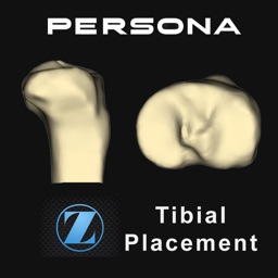 Persona® TKA Tibial Placement