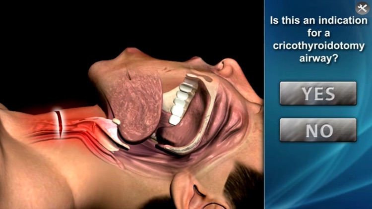 Medrills - Cricothyroidotomy