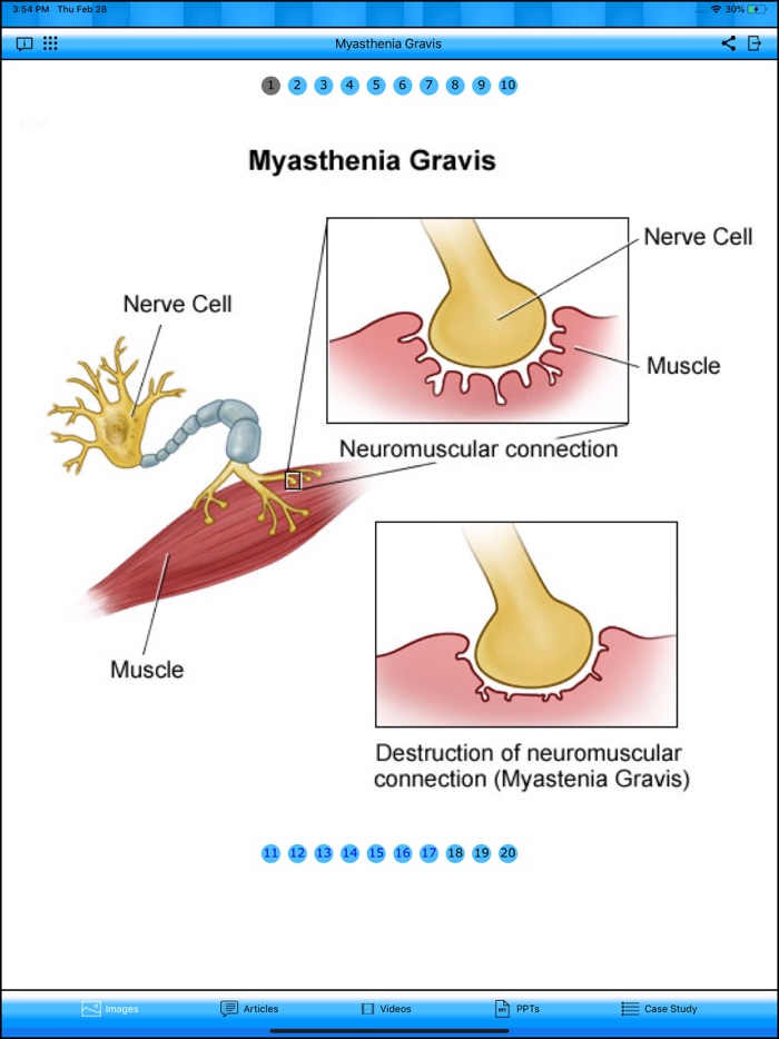 Myasthenia Gravis