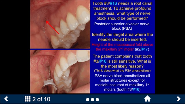 Dental Anesthesia-SecondLook(圖2)-速報App