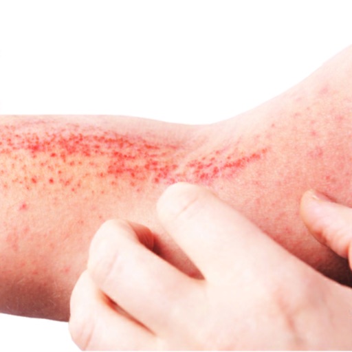 Managing Atopic Dermatitis by Med Learning Group