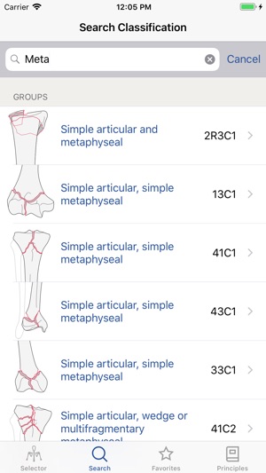 AO/OTA Fracture Classification(圖3)-速報App