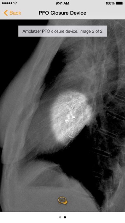 Medical Devices on Chest X-Ray