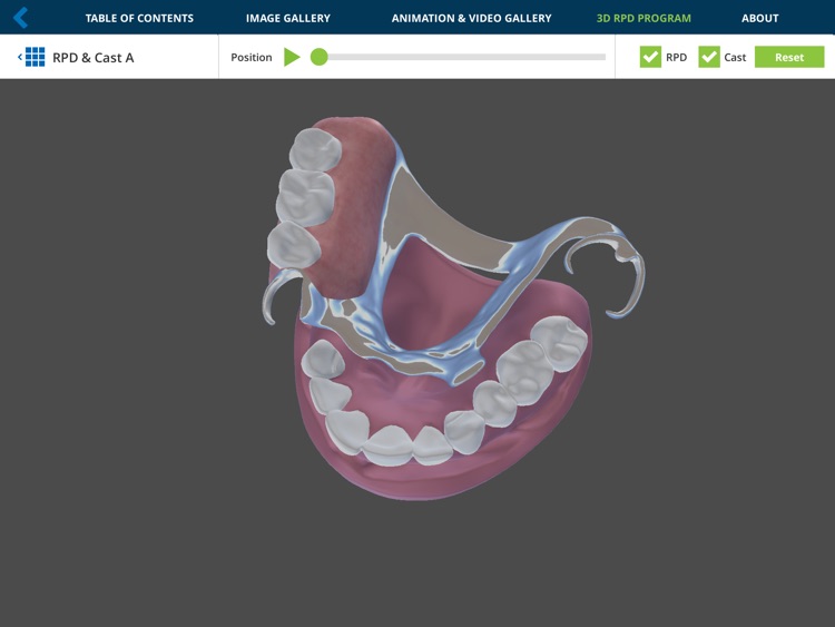 Removable Partial Dentures