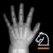 The Gilsanz and Ratib digital Hand Bone Age atlas for iPad, iPhone and iPod Touch brings this essential radiology reference to radiologists, endocrinologists, and pediatricians on the move