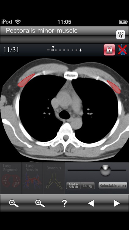 Chest CT Sectional Walker screenshot-3