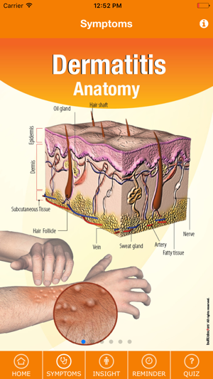 Signs & Symptoms Dermatitis(圖2)-速報App