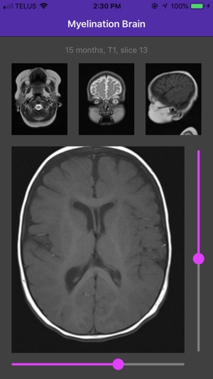 Myelination Brain(圖4)-速報App