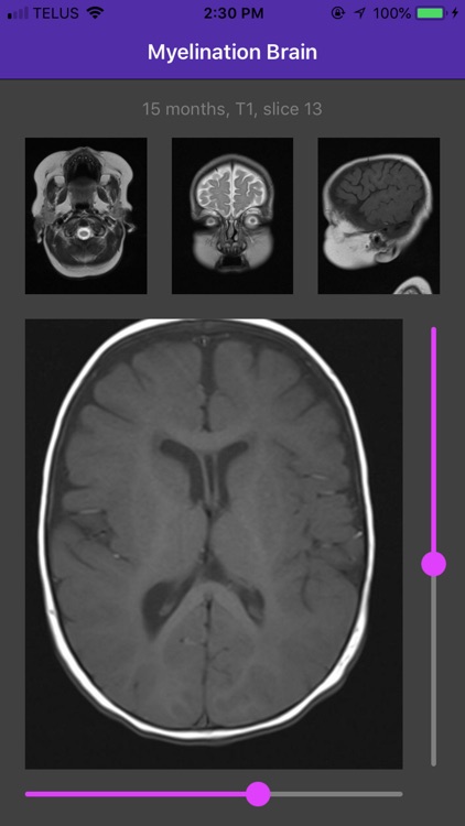 Myelination Brain screenshot-3