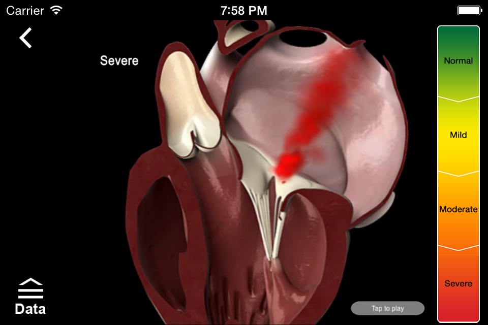 Mitral & Tricuspid Valves screenshot 3