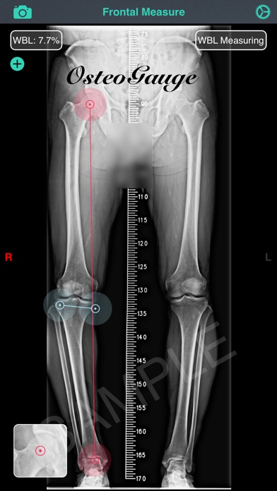OsteoGauge - lower limb screenshot 4