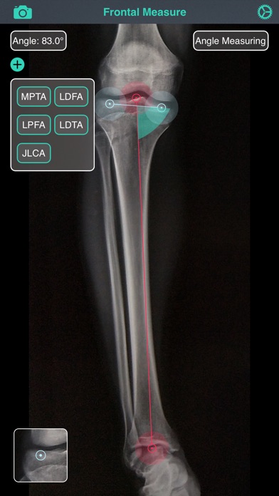 OsteoGauge - lower limb screenshot1
