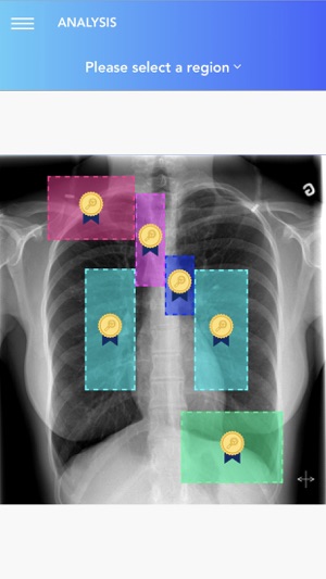 Chest X-Ray Experience(圖7)-速報App