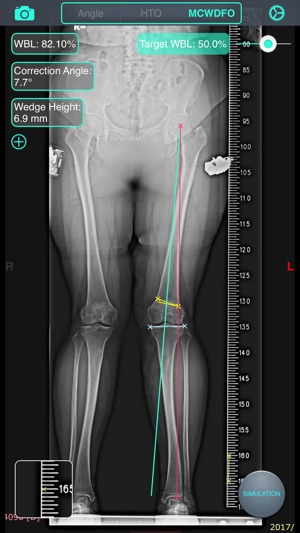 截骨大師 - OsteoMaster(圖5)-速報App