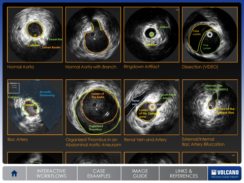 Aortic IVUS screenshot 4