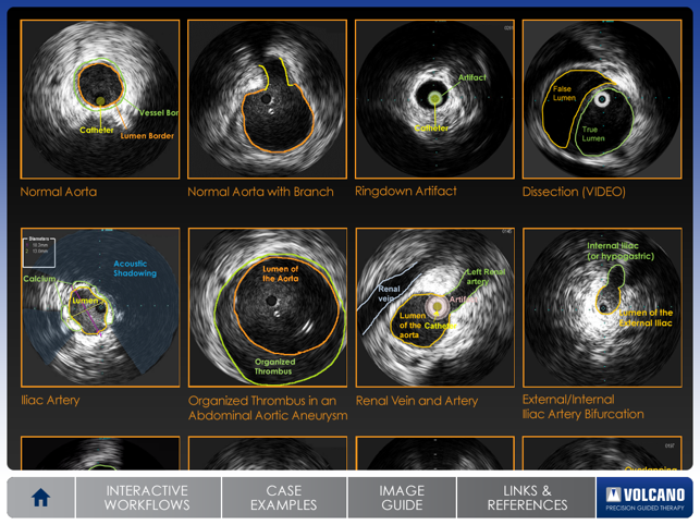 Aortic IVUS(圖4)-速報App