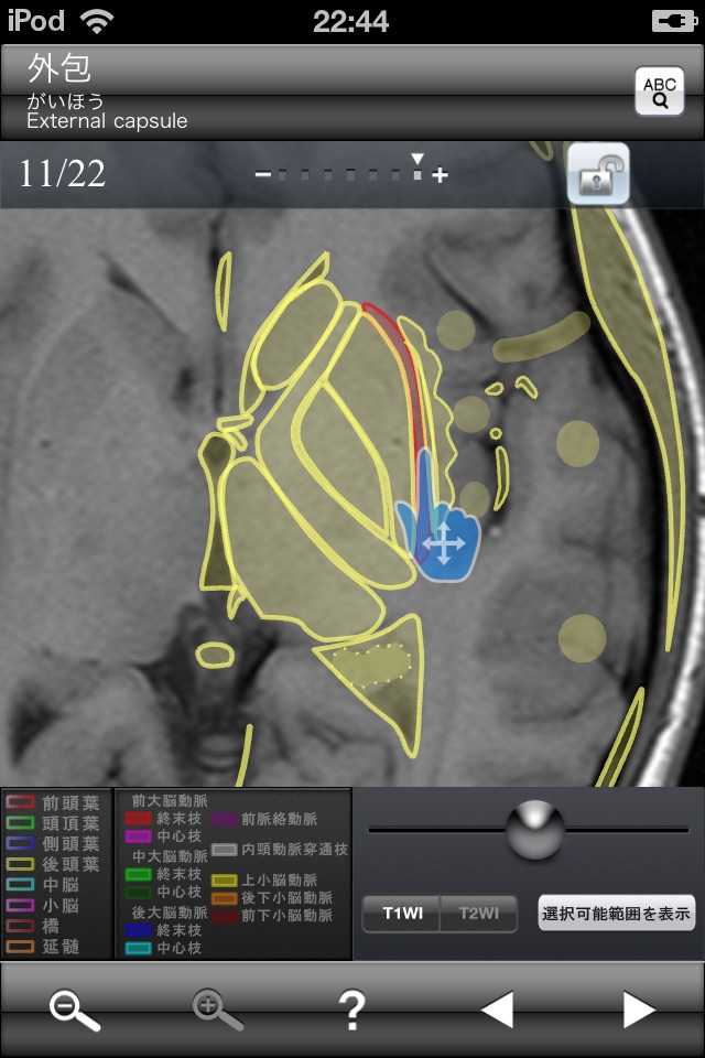 断面図ウォーカー脳MRI screenshot 4