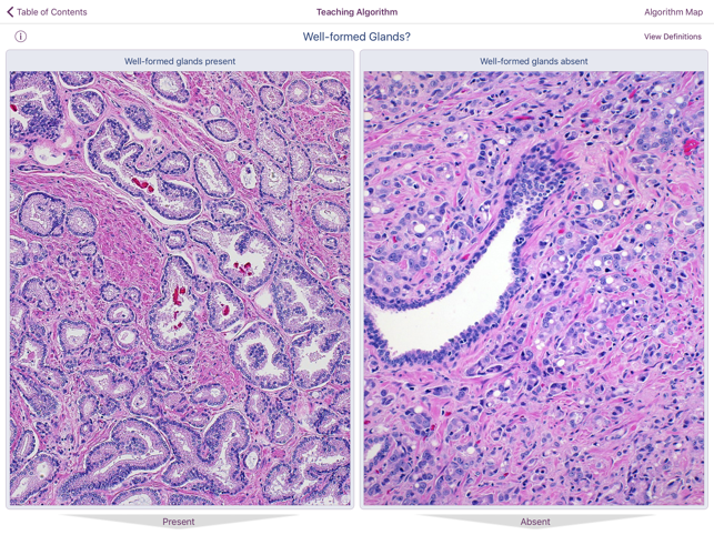 Hopkins Prostate Pathology(圖4)-速報App