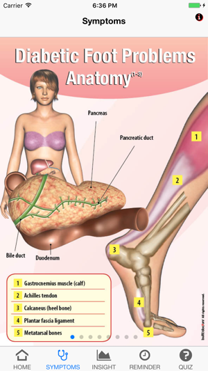 Signs & Symptoms Diabetic Foot(圖2)-速報App