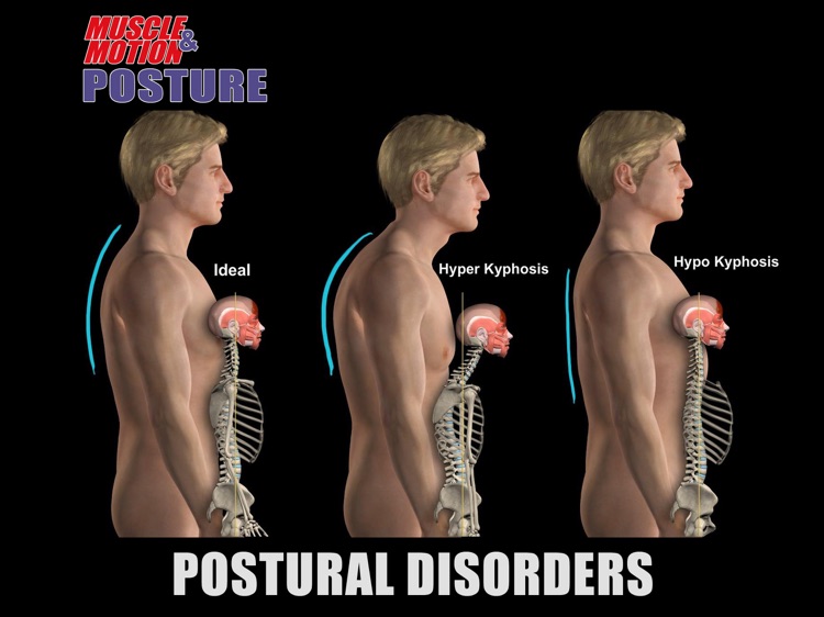 Muscle and Motion - Posture