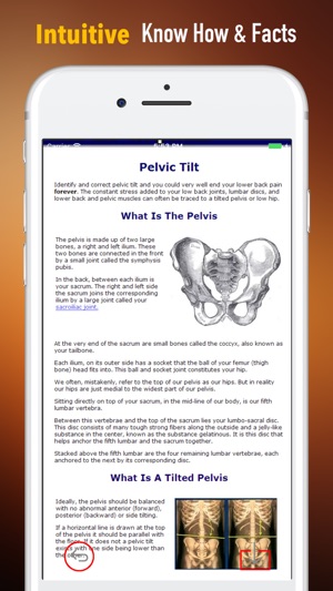 How to Fix Tilted Pelvis-Recovery Guide and Tips(圖1)-速報App