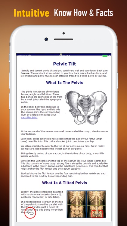 How to Fix Tilted Pelvis-Recovery Guide and Tips