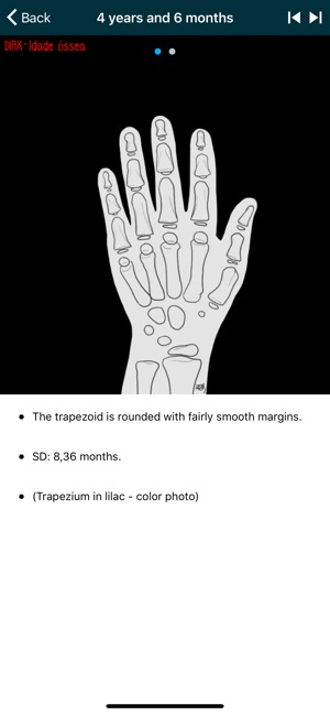 DIAX - Idade Óssea(圖5)-速報App
