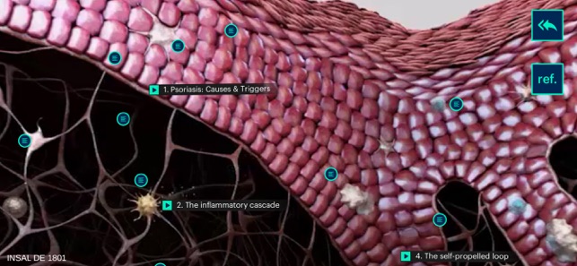 Psoriasis Deep Dive(圖3)-速報App