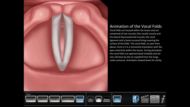 Vocal Pathology: Polyps screenshot-4